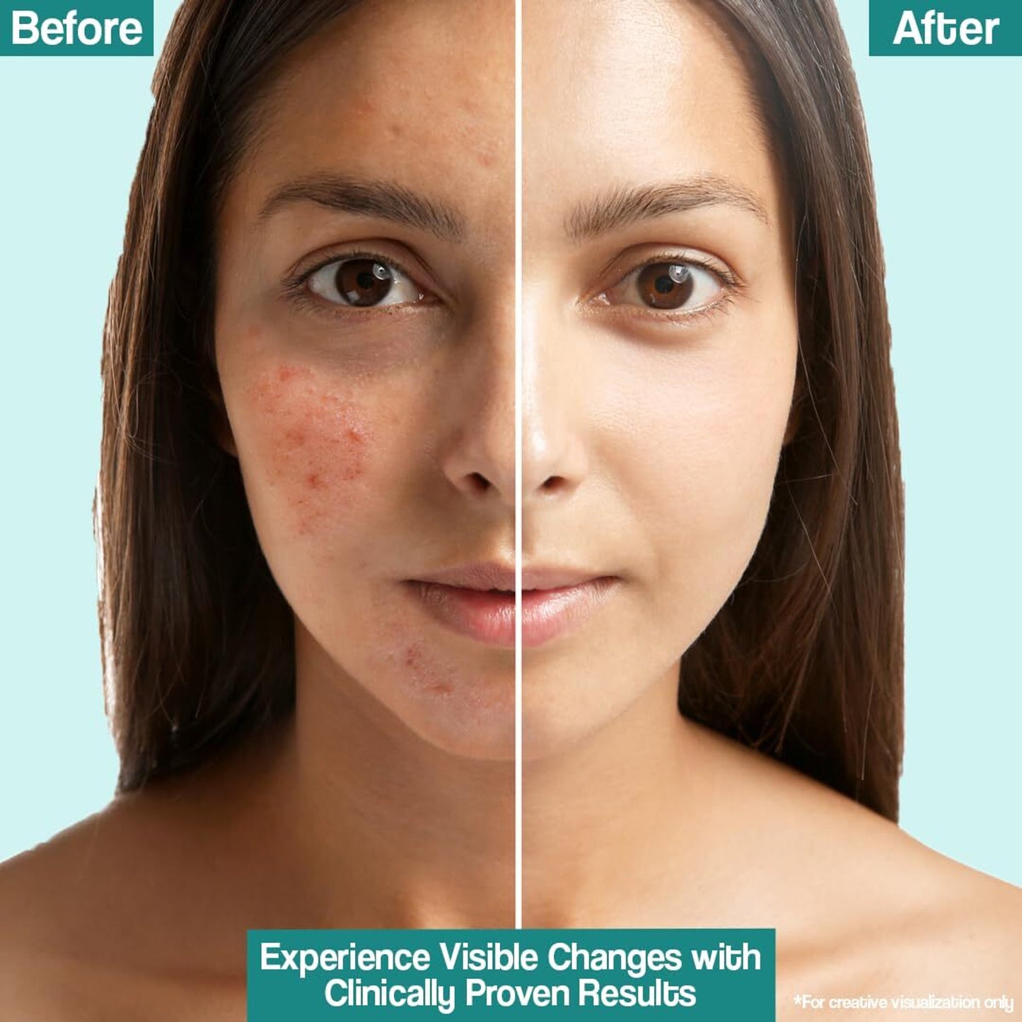 Venusia-Dr.-Reddy's-Venusia-Acne-Control-Moisturizer