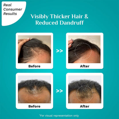 3% REDENSYL & 4%  ANAGAIN ADVANCED HAIR GROWTH SERUM FOR DANDRUFF-PRONE SCALP