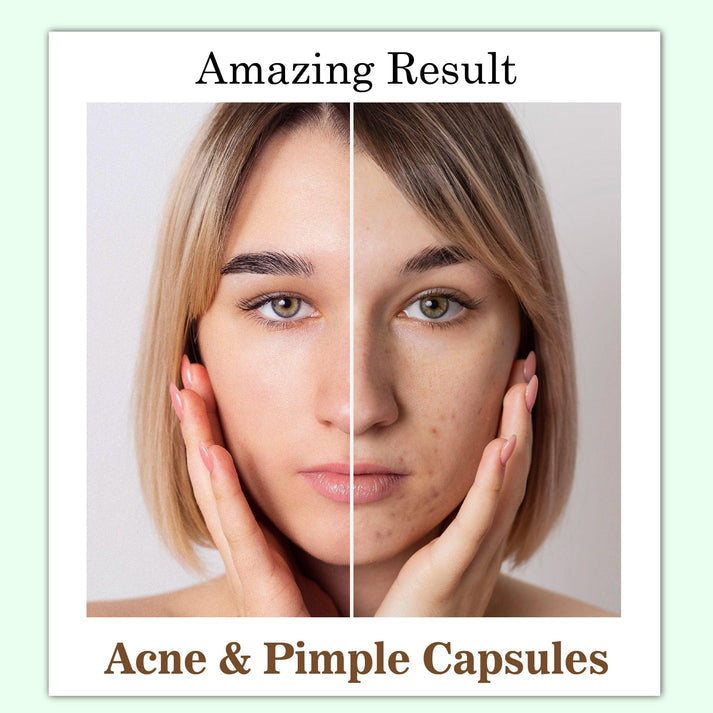 Acne & Pimples Capsule